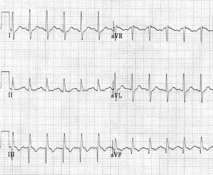 SI QIII TIII pattern in acute PE