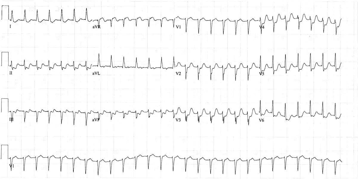 ECG Atrial flutter 2-1 block