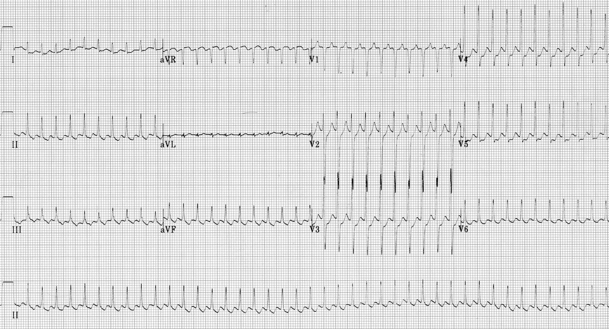 ECG Atrial flutter 1:1 block