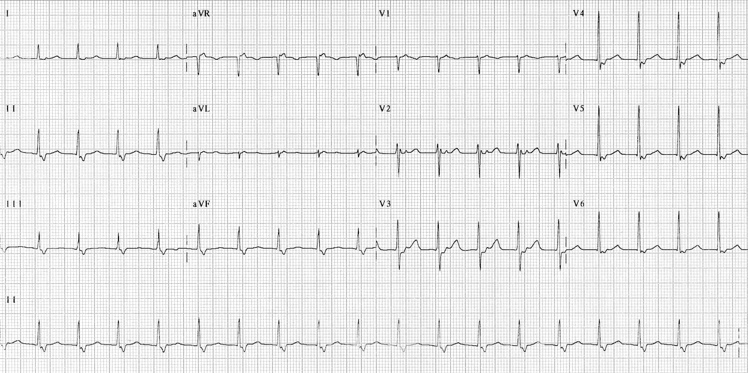 Fast-Slow-AVNRT ECG 4 2