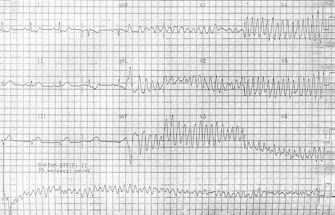 ECG AMI STEMI to VF 2