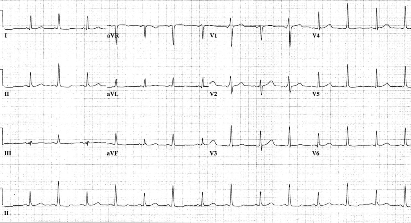 Alternating QRS amplitude and axis