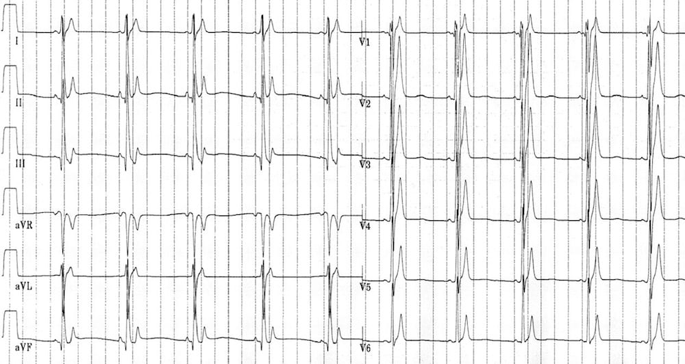 TOP 100 ECG QUIZ LITFL 060