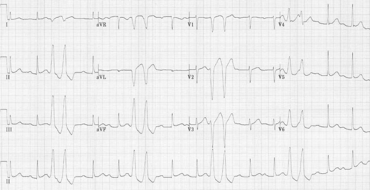 ECG PVC Couplets