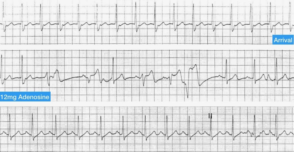 AVNRT-resolves-with-adenosine 3