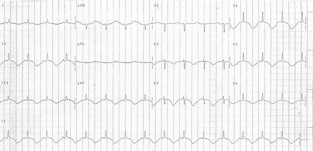 ECG SAH Prolonged QTc TWI