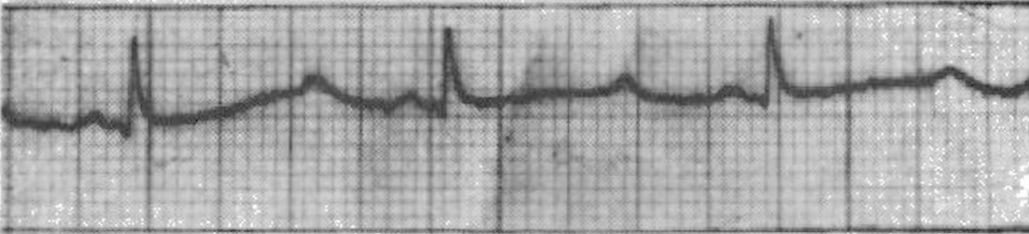 Romano-Ward syndrome prolonged QT in patient BH 1964 2