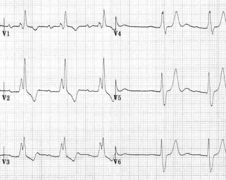Right bundle branch block with T-wave inversion