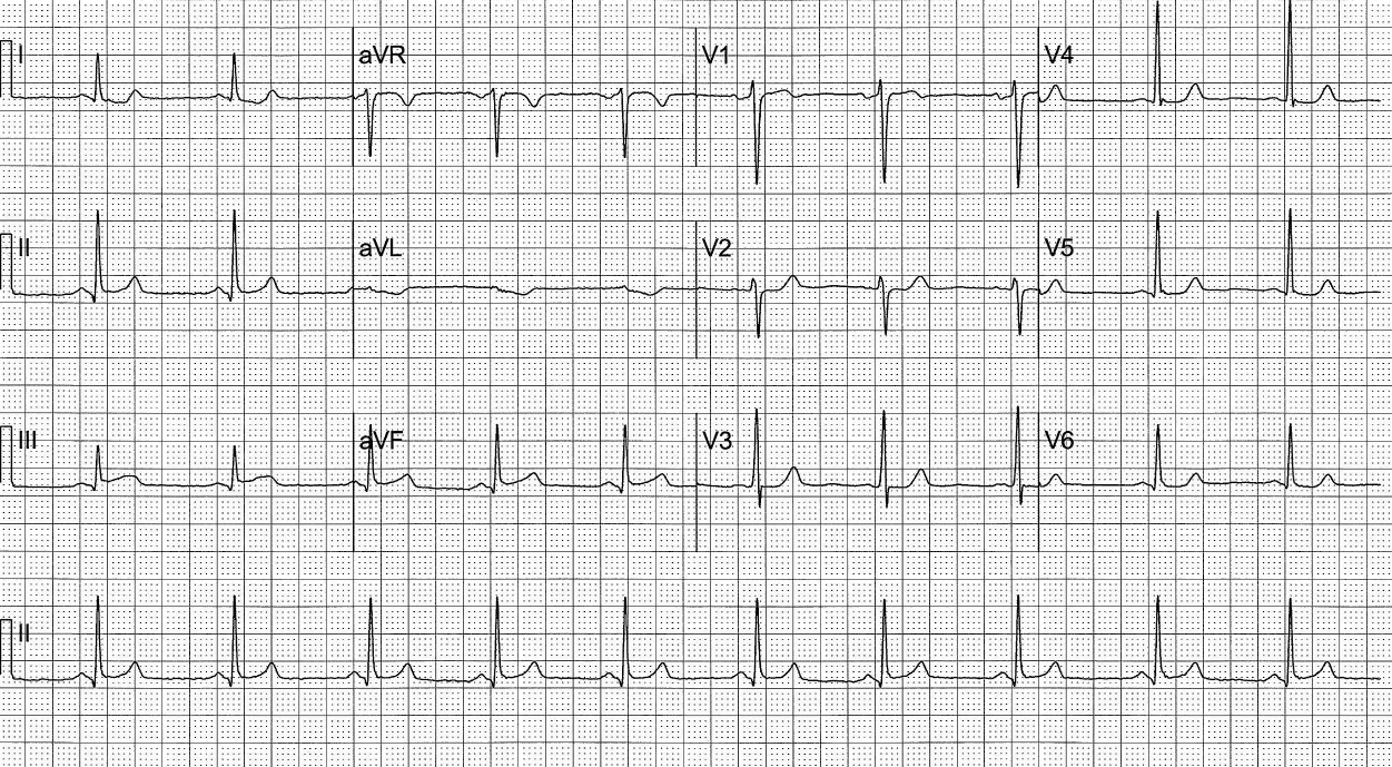 OMI ECG ST-segment changes. some subtle, some obvious