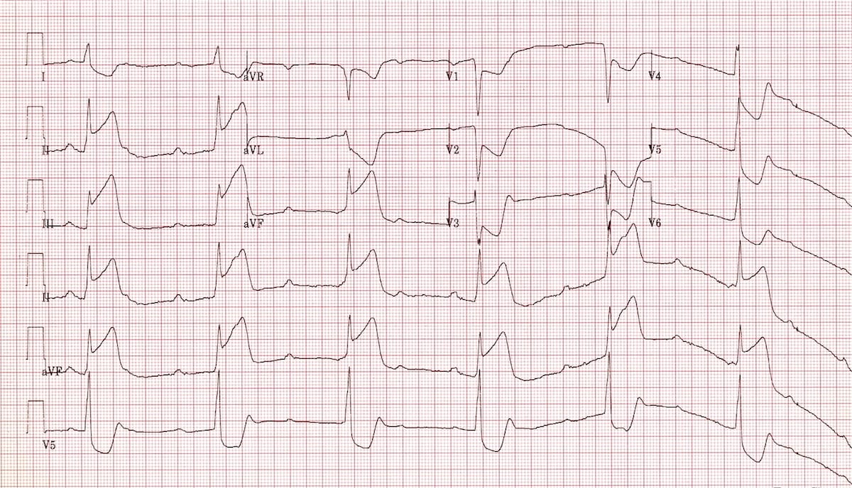 ECG Inferior STEMI with 3rd degree AV Block CHB