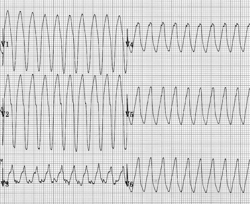 ECG Positive concordance in VT