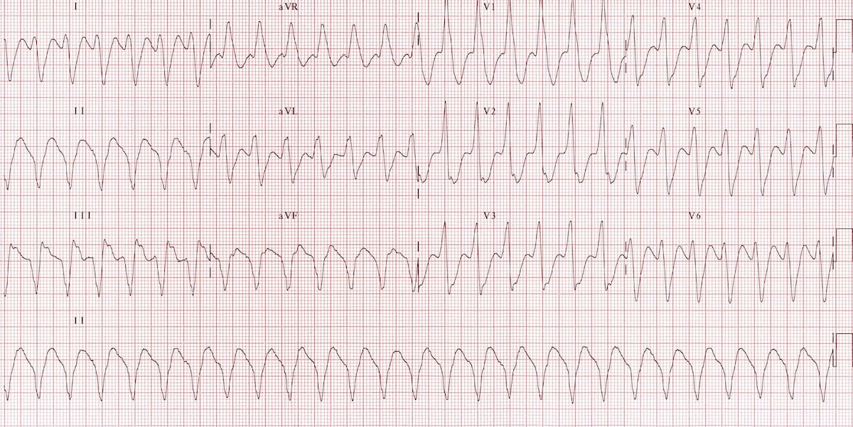 Monomorphic ventricular tachycardia VT 3