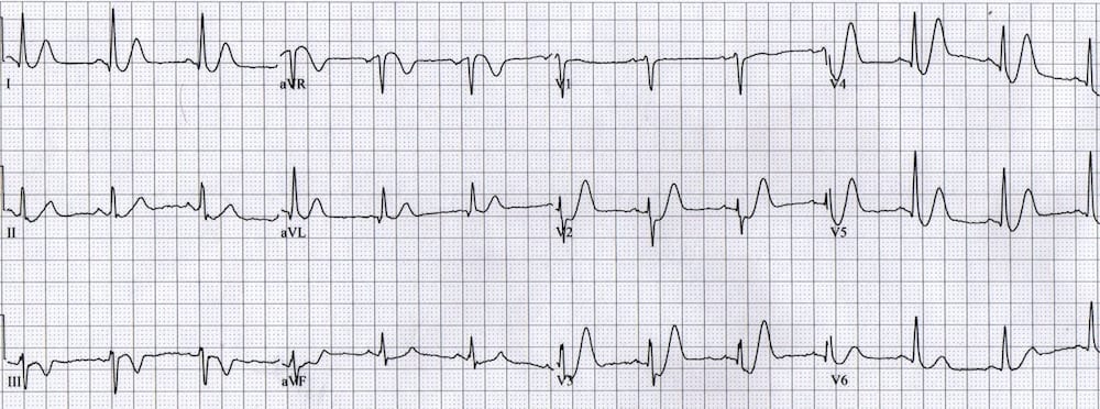 ECG courtesy of Mat Goebel