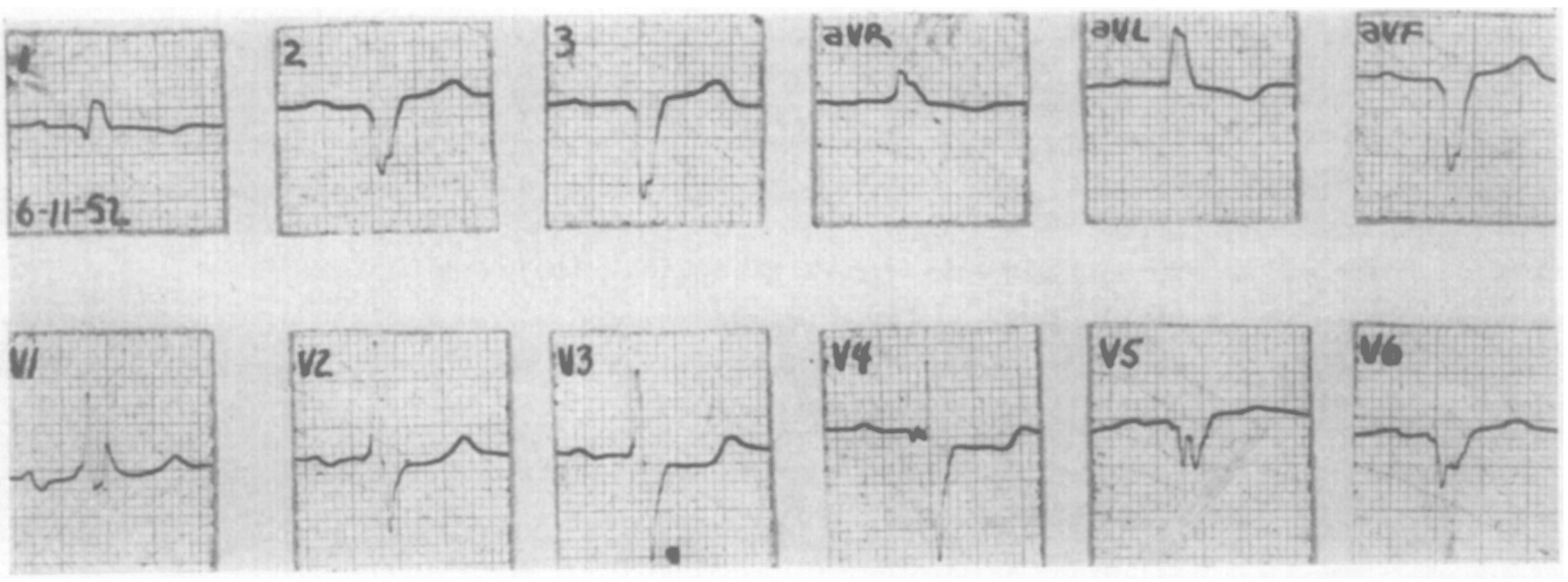 Richmann Wolff 1954 LBBB RBBB case 1