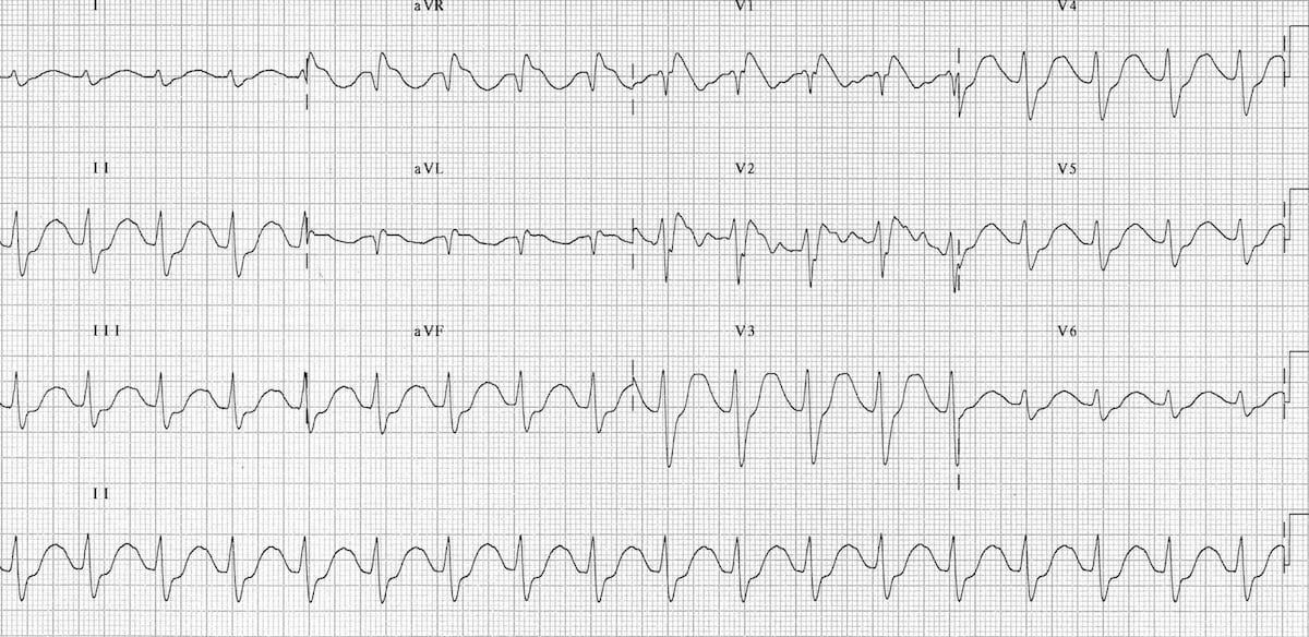 ECG TCA toxicity 1 2