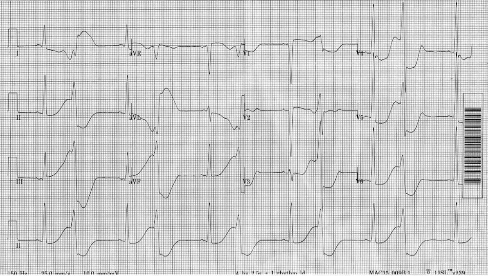 TOP 100 ECG QUIZ LITFL 059