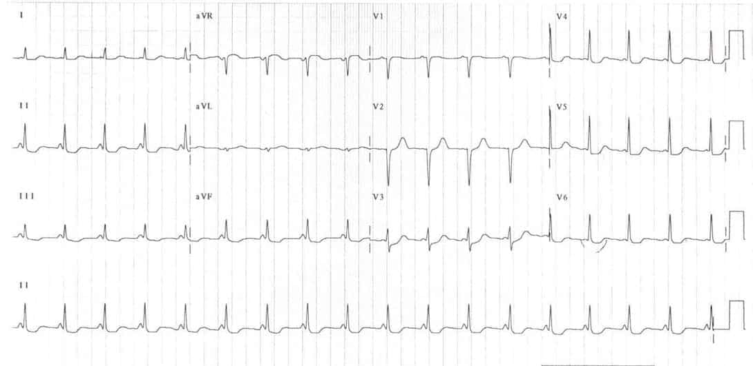Lown–Ganong–Levine syndrome (LGL)