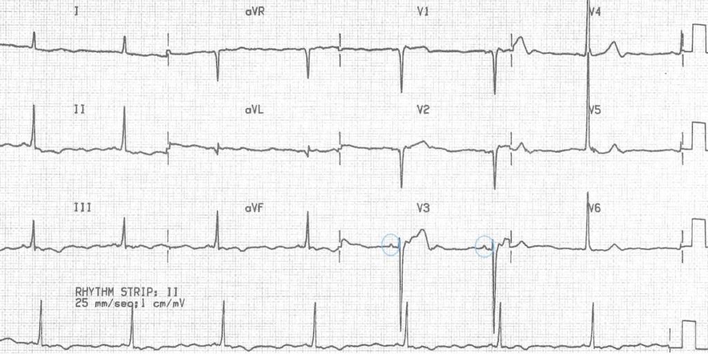 tremor-artefact-parkinsons 2