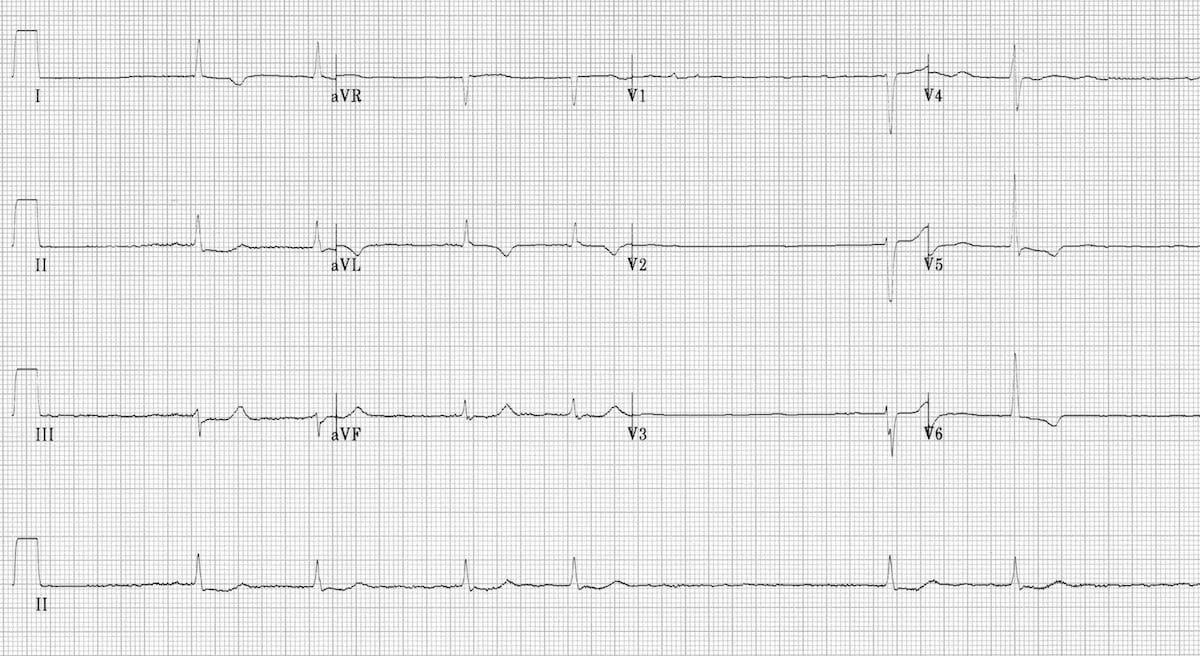 ECG Atrial Fibrillation Slow ventricular response