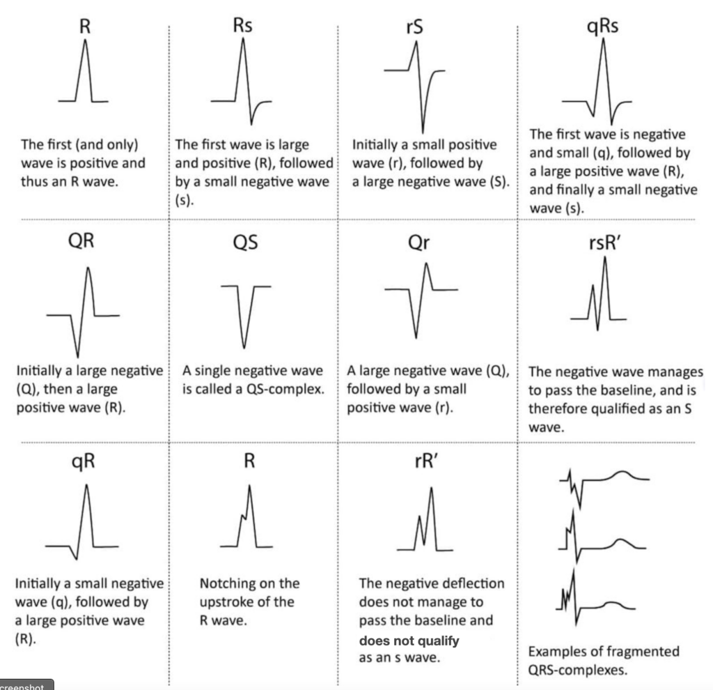 Naming-of-the-QRS-complex-ECGWAVES 2