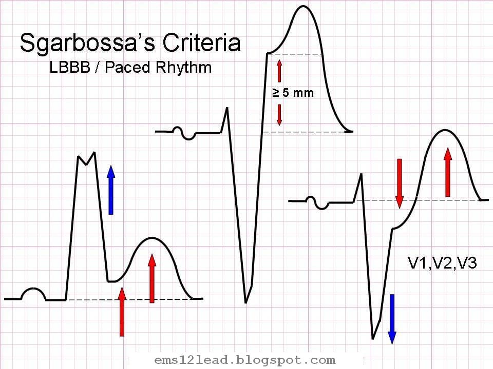 Sgarbossa Criteria ECG LBBB Paced rhythm