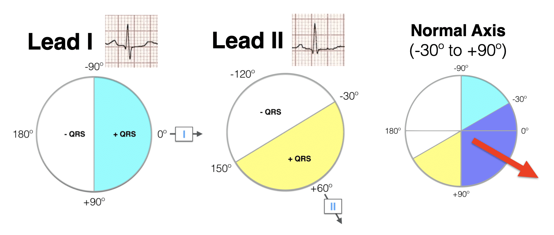 Lead I Lead II hexaxial analysis Normal axis 2021