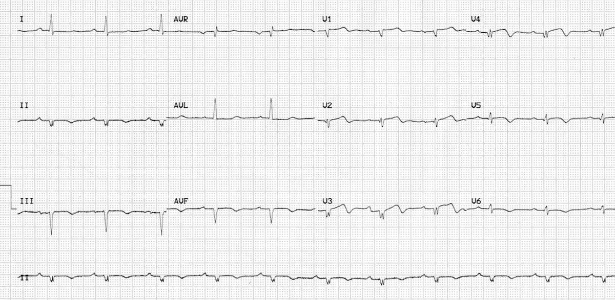 Low voltage in V1-6 due to prior massive anterior MI