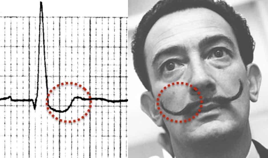Digoxin effect reverse tick salvador dali moustache