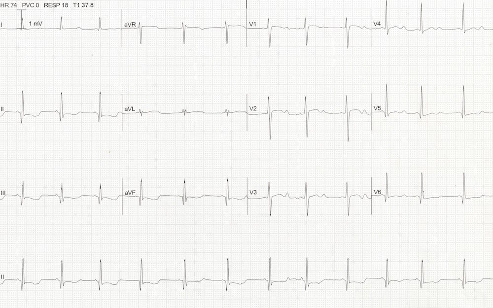 ECG Hypokalaemia QTc 500 potassium 1.9