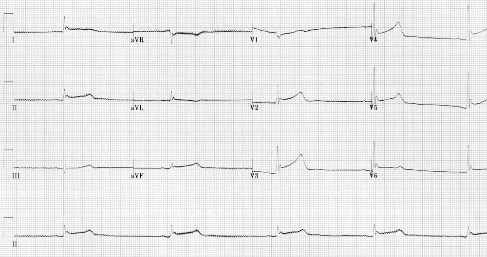 TOP 100 ECG QUIZ LITFL 010