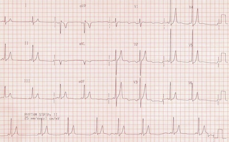 ECG SAM Super Axis Man 001 ECG
