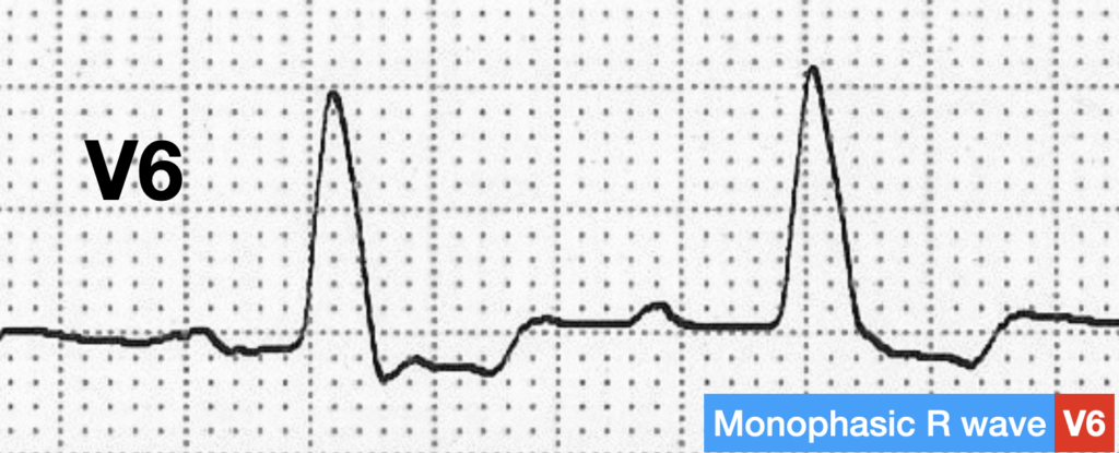 LBBB QRS morphology monophasic R wave