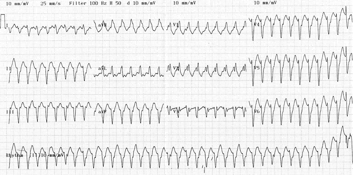 Monomorphic-ventricular-tachycardia-VT-71