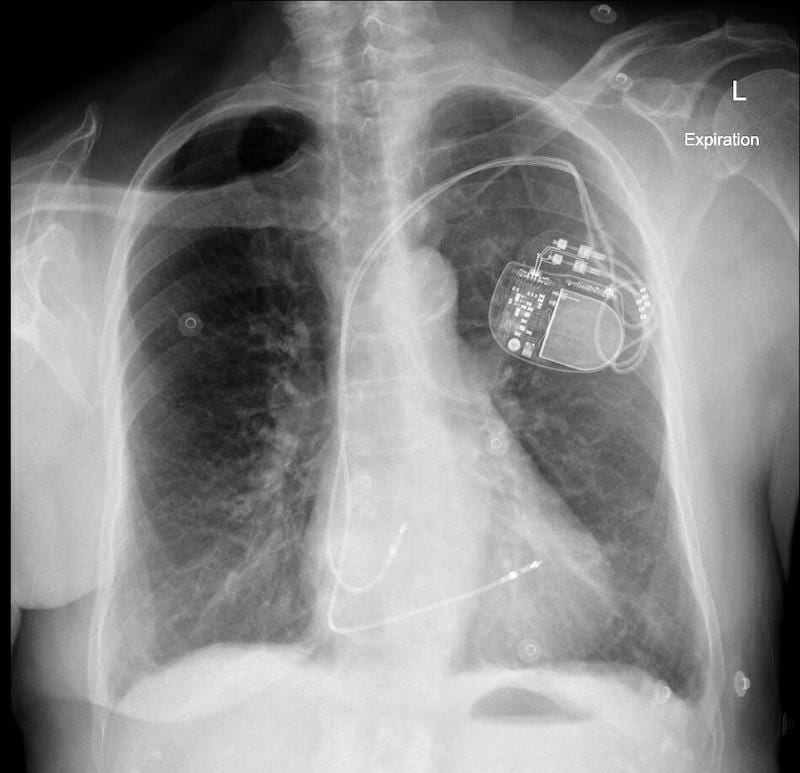 ECG Case 111 AP CXR PPM Normal