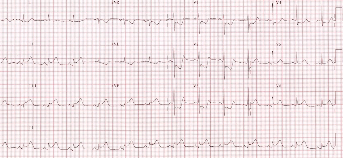 ECG Posterior AMI 4a