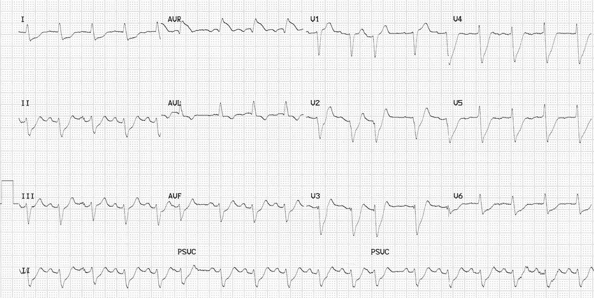 ECG LMCA Occlusion 1 Left main coronary artery (LMCA)