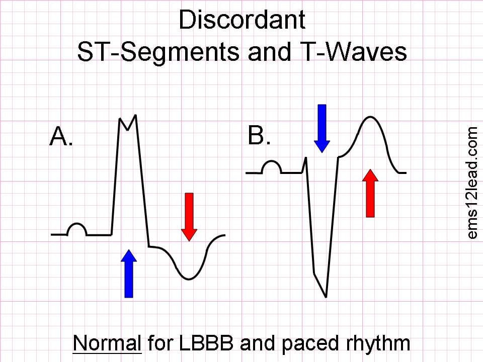 Sgarbossa Criteria ECG discordant ST segments and T waves