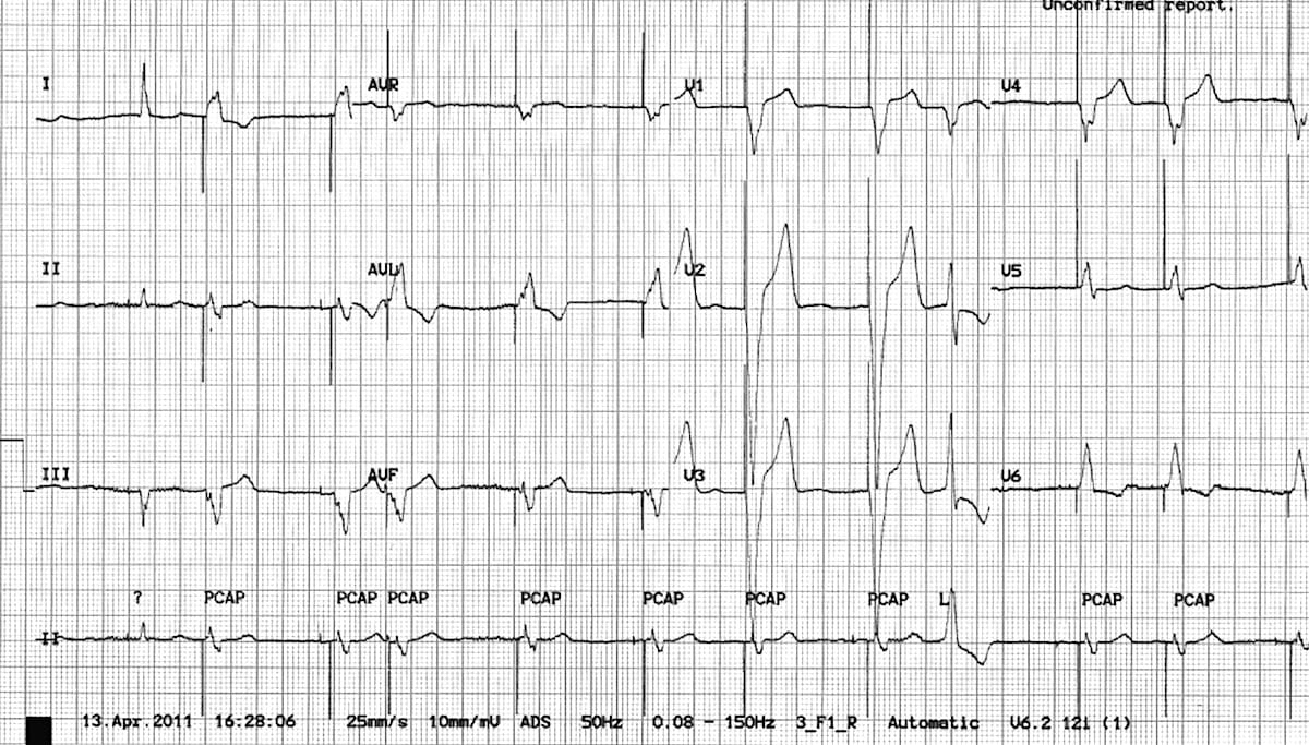 ecg991 2