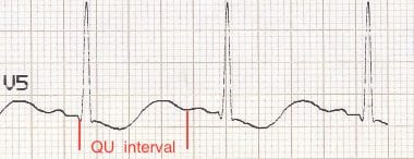 QU interval ECG Hypokalaemia