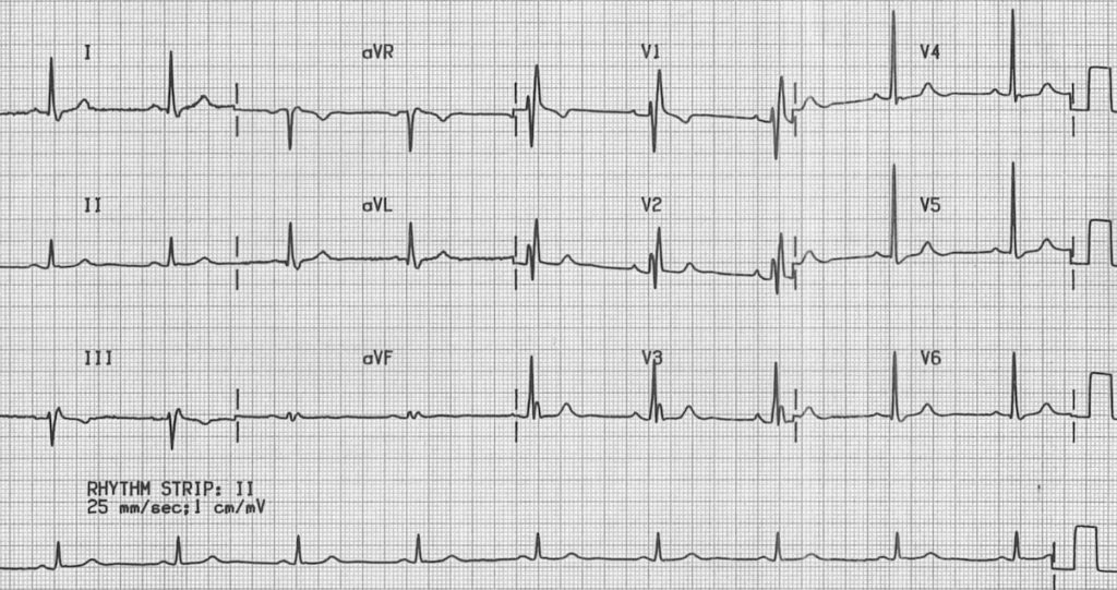 ECG Right Bundle Branch Block RBBB 3