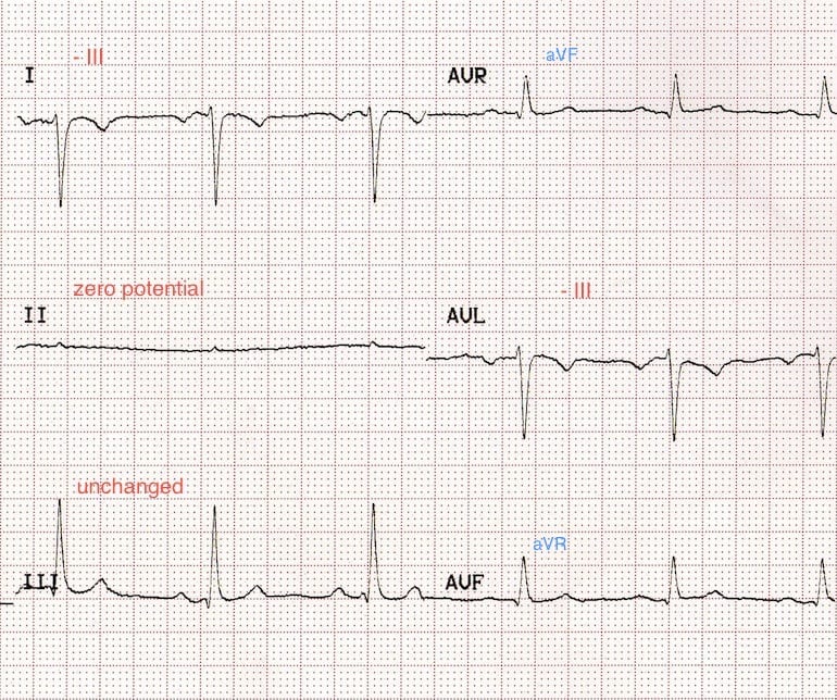 ECG Lead reversal RA-RL