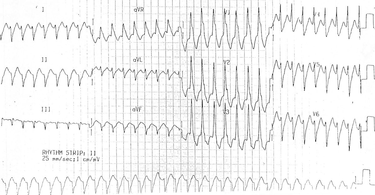 Monomorphic ventricular tachycardia VT 5