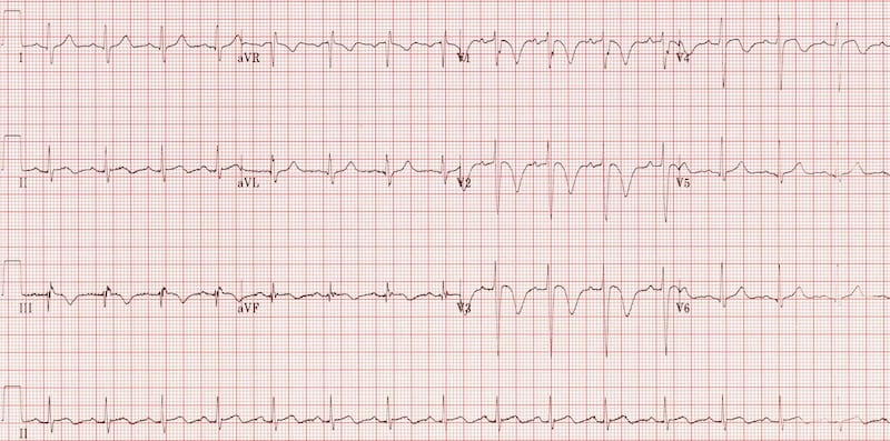 massive pulmonary embolism ECG T wave inversion