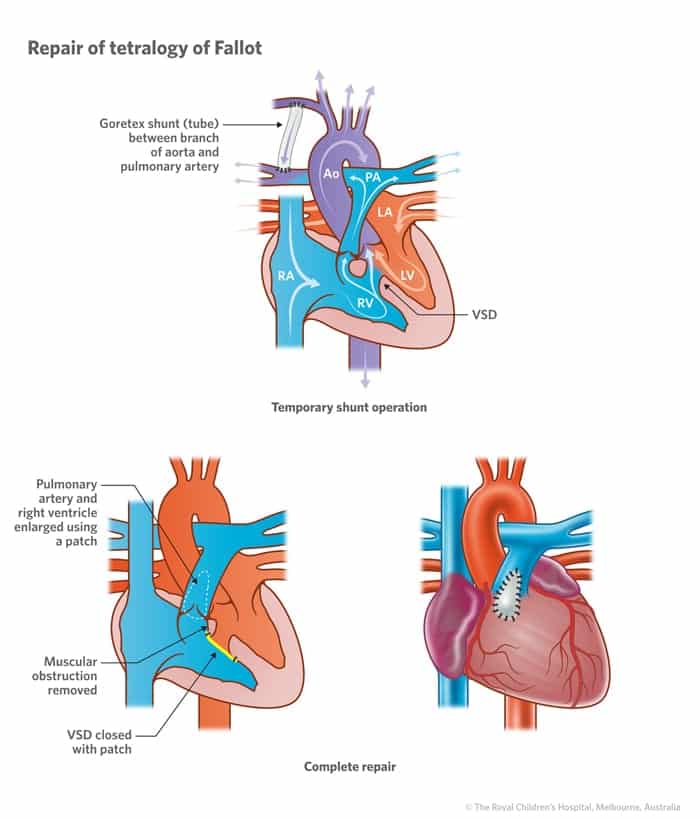 Fallots Tetralogy repair