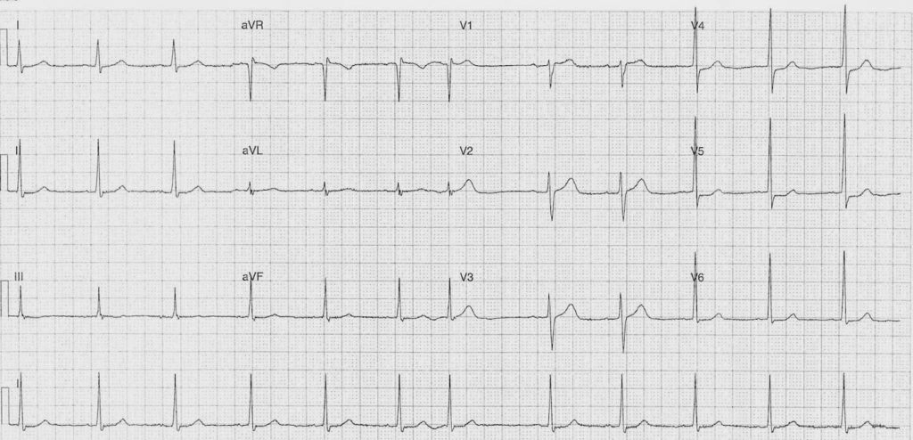 ECG Case 085a LITFL Top 100 EKG