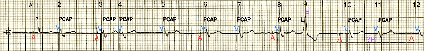 ecg99-rhythm-strip2
