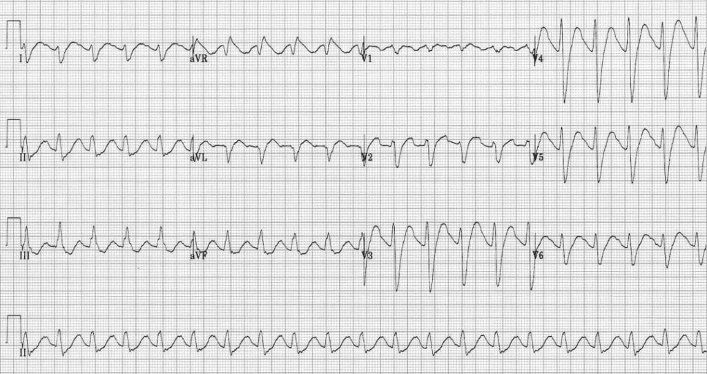 TOP 100 ECG QUIZ LITFL 004