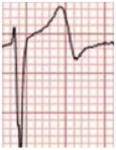 ECG Wellens Type 2 Complex