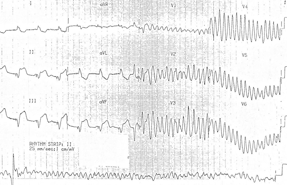 TOP 100 ECG QUIZ LITFL 057
