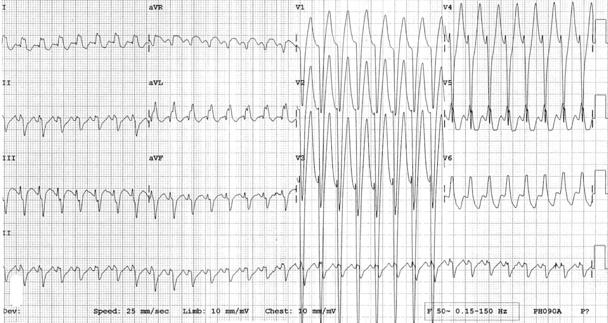 ECG WPW AVRT 15 year old 2 2